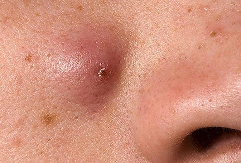 Ảnh mụn đầu đinh đã có mủ, dấu hiệu sắp vỡ hoặc cần can thiệp